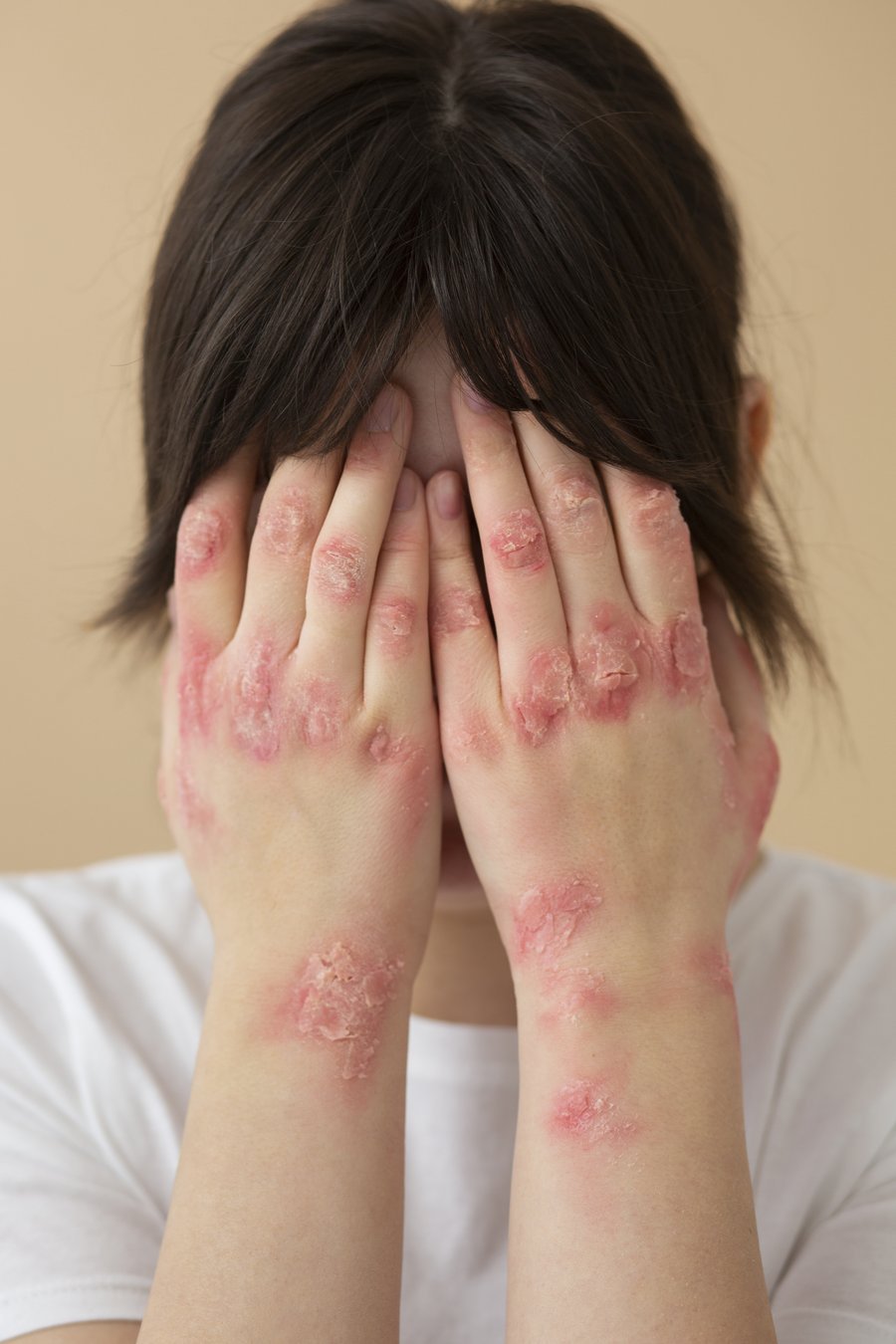 Psoriasis care journey