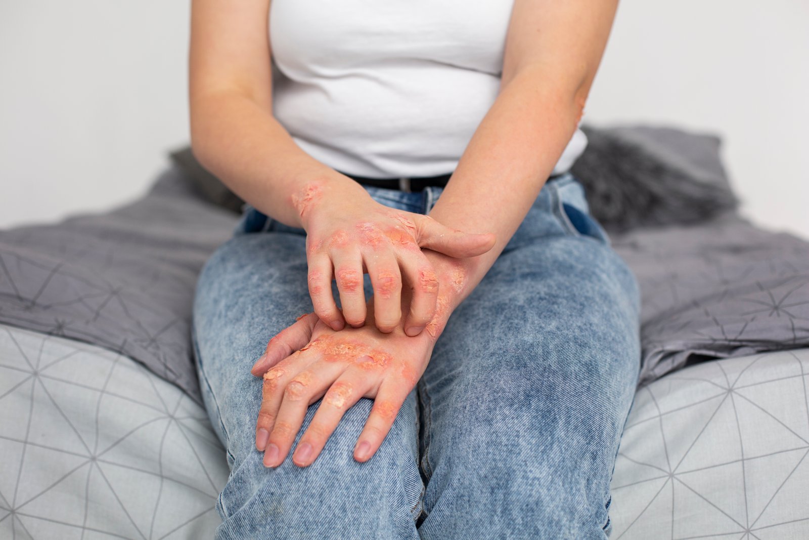 Ayurvedic psoriasis skin care